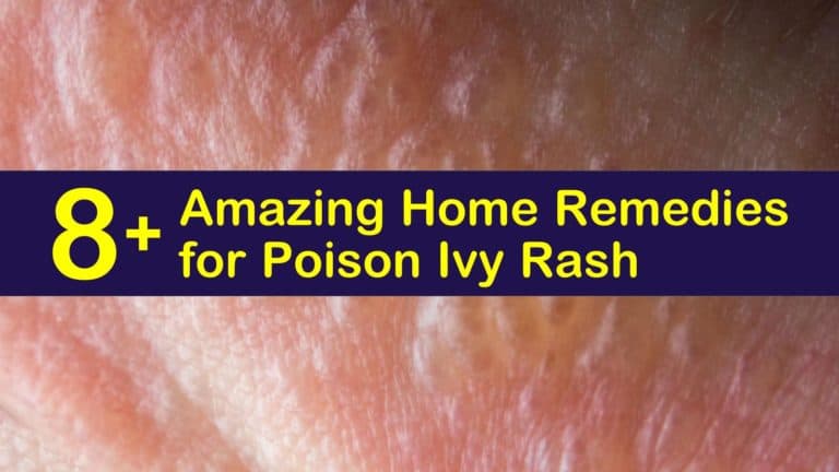 8+ Amazing Home Remedies for Poison Ivy Rash
